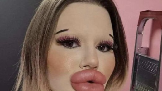 24-year-old-bulgarian-woman-wants-to-have-the-biggest-lips-in-the-world