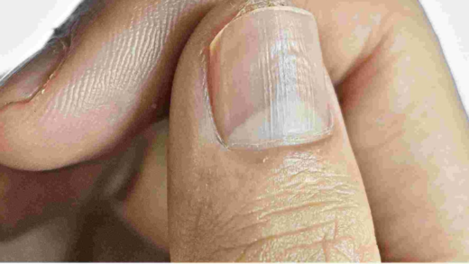 understanding-the-real-causes-of-vertical-ridges-on-your-nails